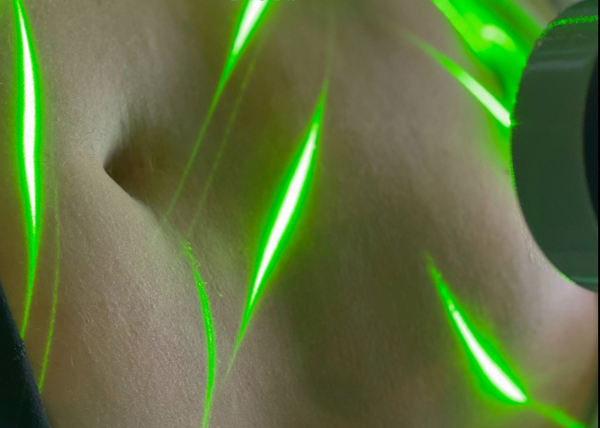 зеленый лазер для лечения ожирения